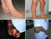 Figure 1. . Different localization and severity of tendon xanthomas in CTX.